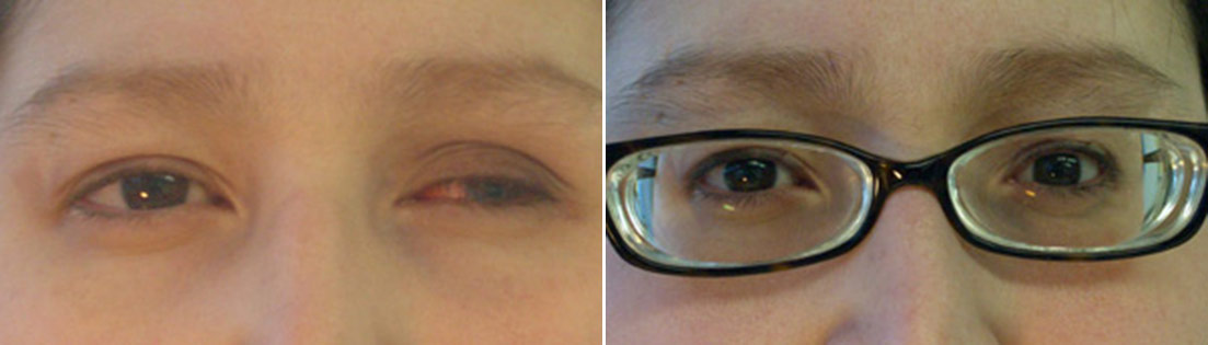 Patient of prosthetic shells before and after photos.