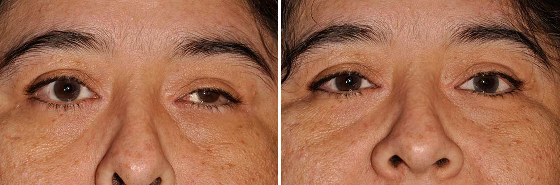 Patient of prosthetic shells before and after photos.