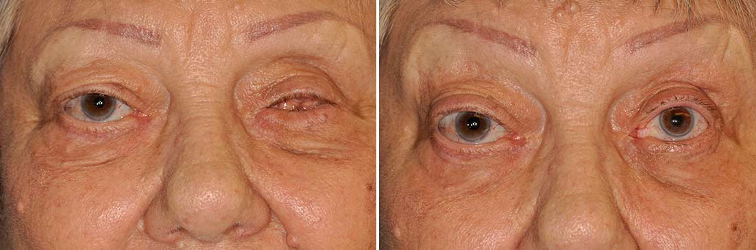 Patient of prosthetic shells before and after photos.