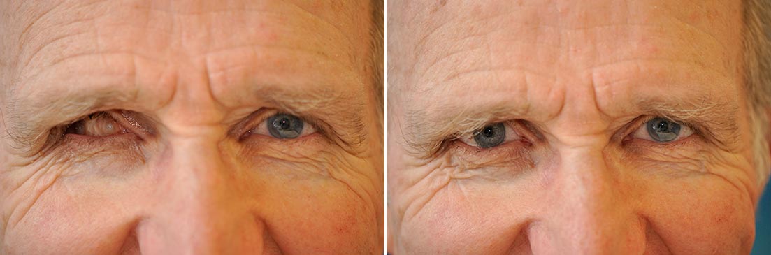 Patient of prosthetic shells before and after photos.