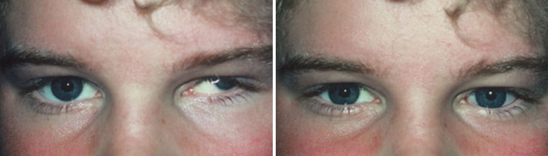 Patient of prosthetic shells before and after photos.