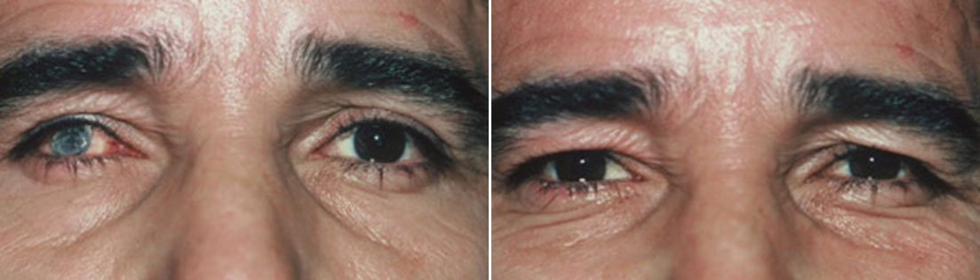 Patient of prosthetic shells before and after photos.