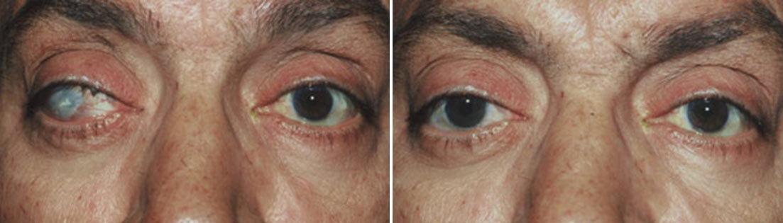 Patient of prosthetic shells before and after photos.