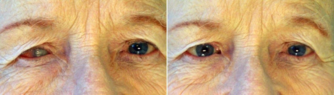 Patient of prosthetic shells before and after photos.