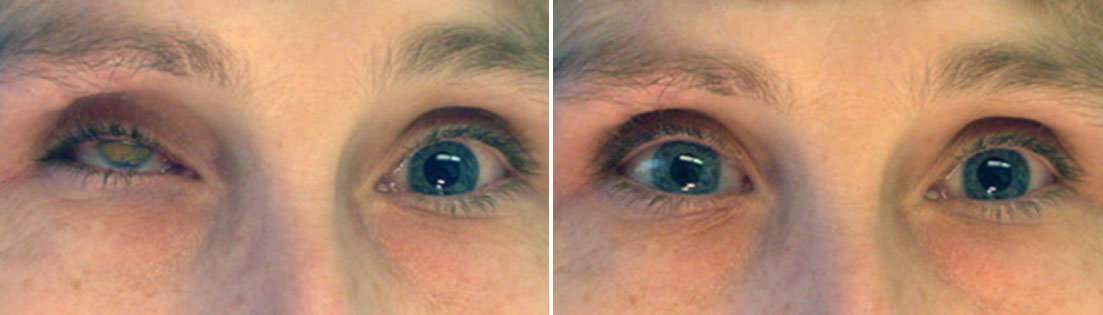 Patient of prosthetic shells before and after photos.